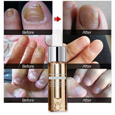 Vibrant Glamour Nail Repair Fluid Hand and Foot Nail Fungus Care Bright Nail - VitaGlow Beauty Co.